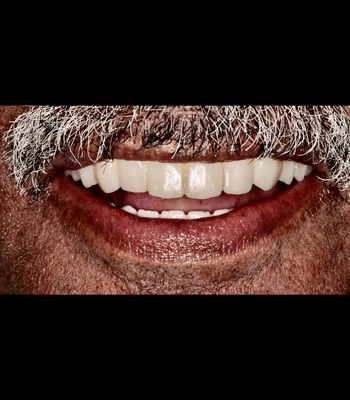 After: Implant Restoration